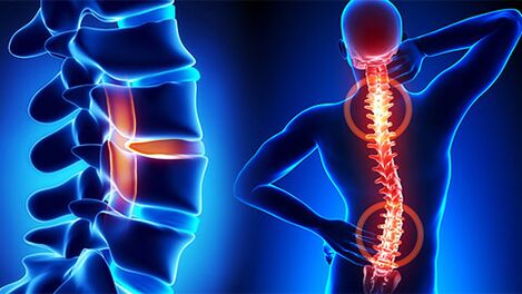osteocondroza coloanei vertebrale la femei durere bruscă de genunchi
